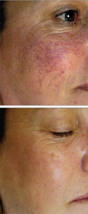 Laser Vein Removal Side Image