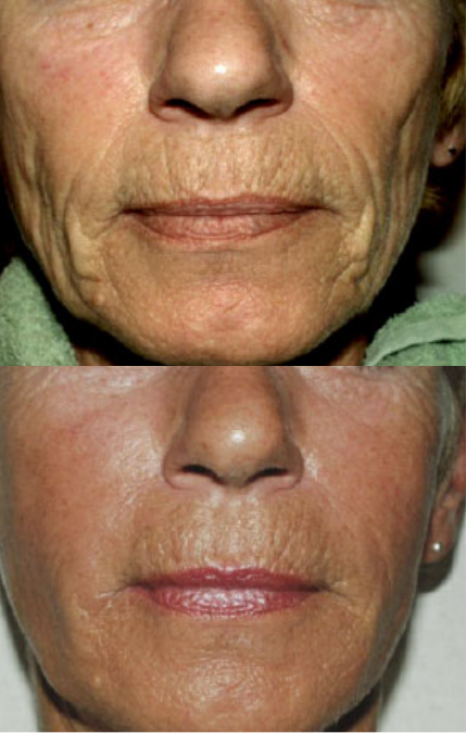 Sculptra Side Image