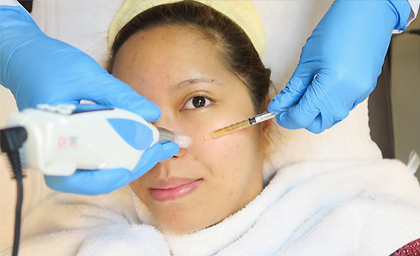 PRP Facial Side Image